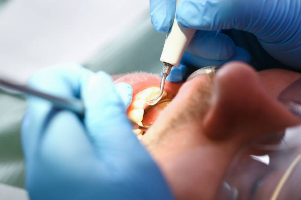 Best Emergency Wisdom Teeth Removal in Ville Ptte, LA